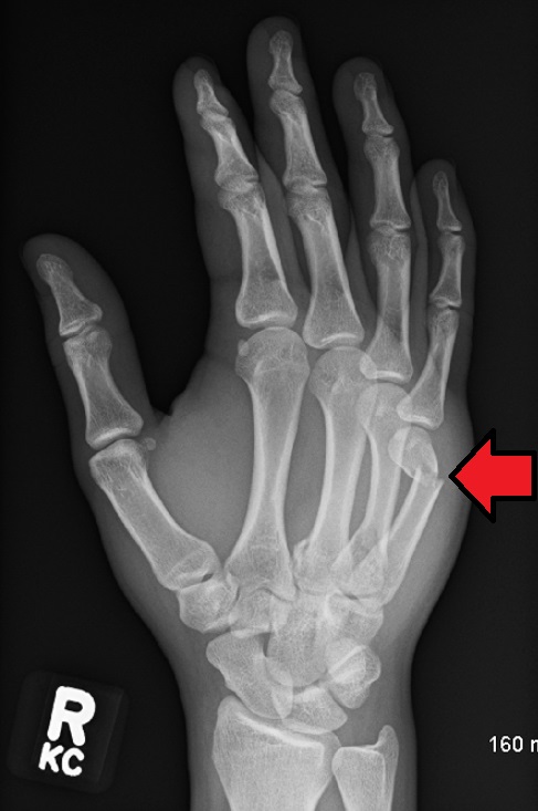 Boxer S Fracture Image Radiopaedia Org Boxer S Fracture Image Radiopaedia Org