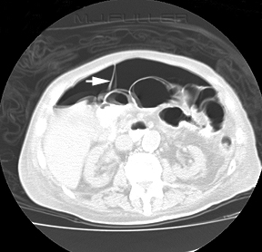 Free Air on Abdomen CT: Causes & Diagnosis Explained