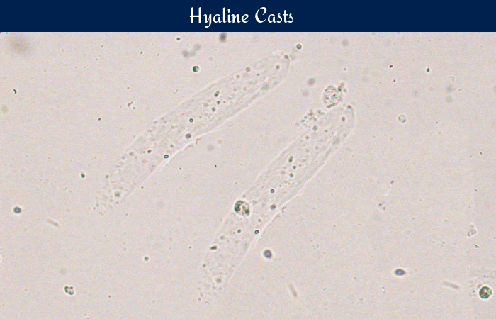 Hyaline Casts 10-20: What It Means for Your Health