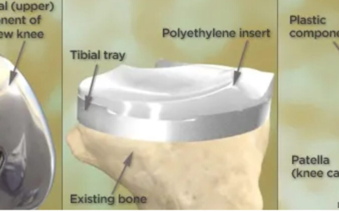 Knee Replacement Explained Dr Peter Smith Orthopaedic Surgeon Knee Replacement Explained Dr Peter Smith Orthopaedic Surgeon