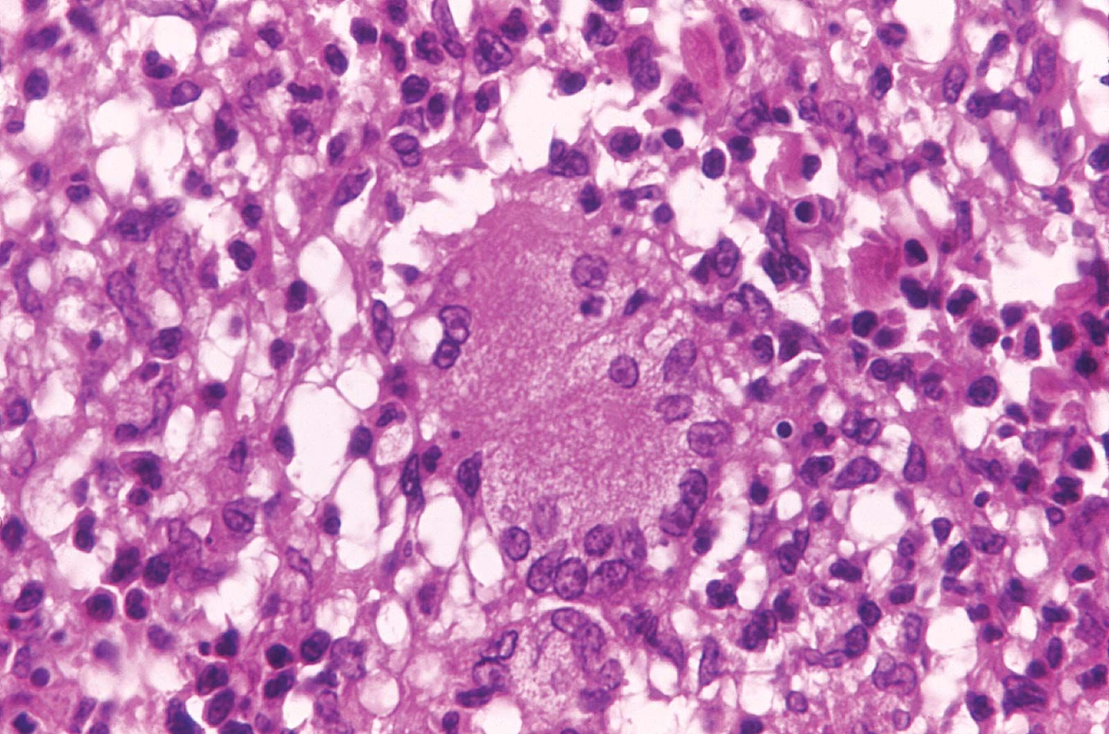 Mycobacterium Leprae Gram Stain Mycobacterium Leprae Gram Stain