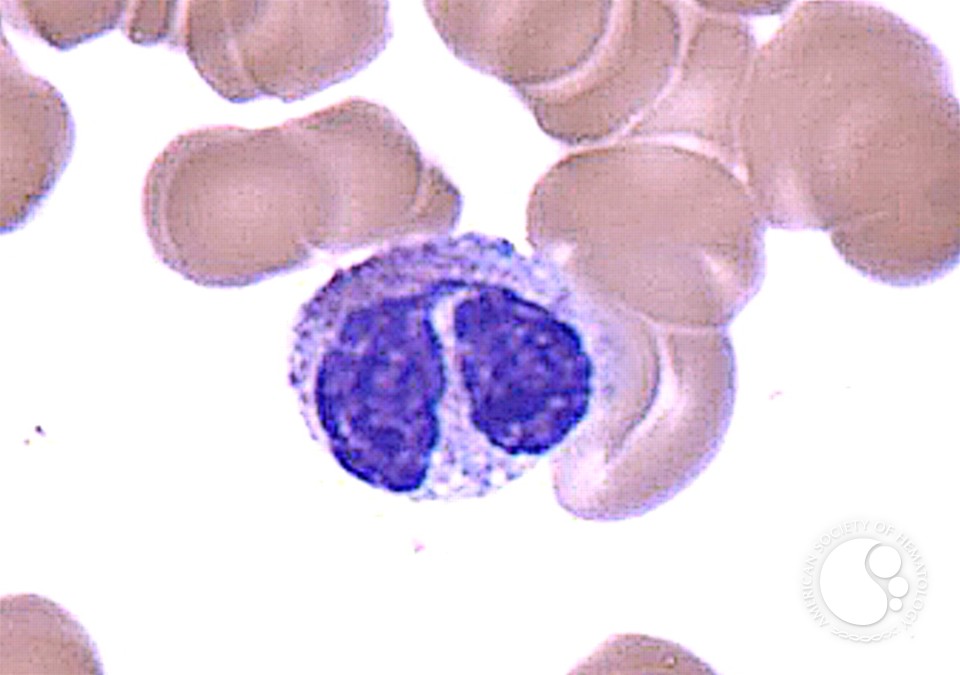 Understanding Pelger-Huët Cells: Causes and Implications